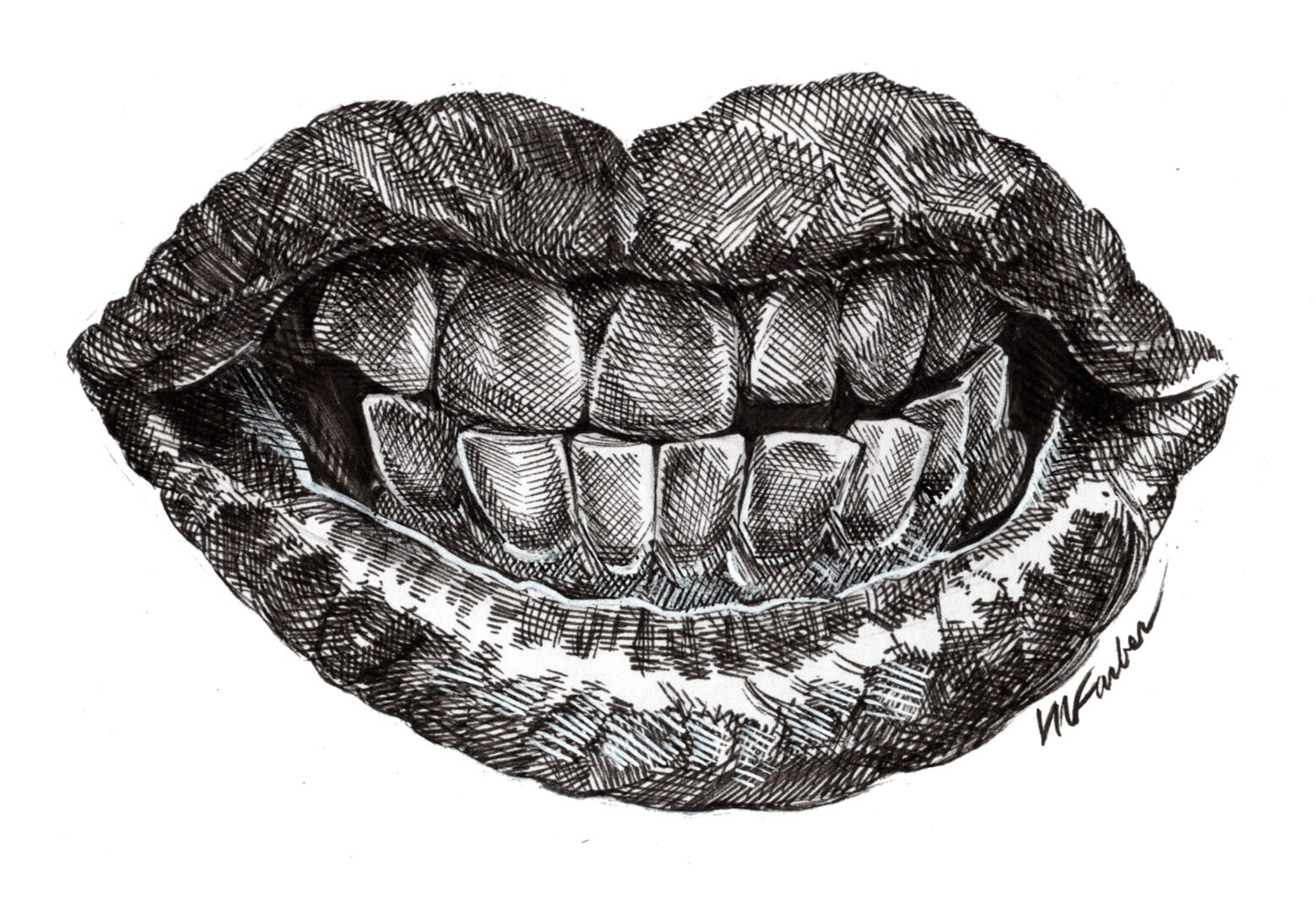 Bruxism